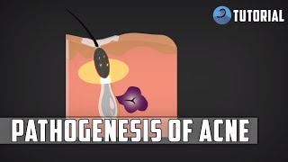 Acne Pathophysiology  Acne Vulgaris Pimples Pathogenesis [upl. by Karsten]