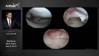 Arthroscopic Knee Surgery  Meniscus Surgery Performed by Dr Millstein [upl. by Zendah]