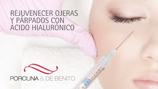 Rejuvenecer ojeras y párpados con ácido hialurónico [upl. by Cyrillus]