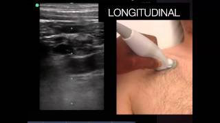 UltrasoundGuided Central line tutorial [upl. by Grimbly]