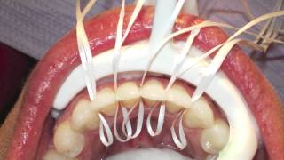 Retanium Splint Placement Orthodontics [upl. by Holzman]