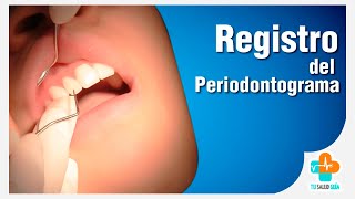 Registro del Periodontograma  Tu Salud Guía [upl. by Arlette]