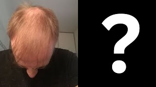 Norwood 5 FUE Hair Transplant by Dr Arshad [upl. by Htbazile731]