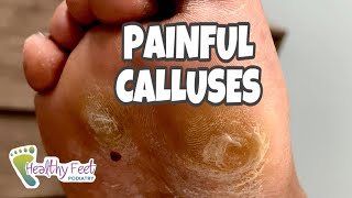 CALLUS REMOVAL AT HOME SO SATISFYING [upl. by Rehtae]