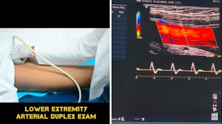 Lower Extremity Arterial Duplex Exam [upl. by Chesney481]