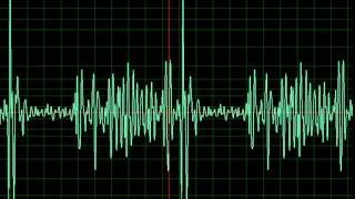 Mitral Stenosis slow [upl. by Lorrayne]