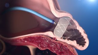 WATCHMAN Implantation Technique [upl. by Frazier]