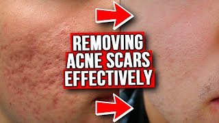 GET RID OF ACNE SCARS FROM EXPERIENCE [upl. by Puett254]