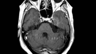 HSV Encephalitis [upl. by Lirrad]