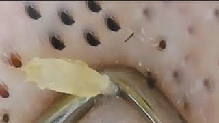 Big Old Blackhead Removal Video [upl. by Lehte400]