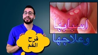 ❓كيف تتخلصون من تقرحات الفم ؟ و طرق تجنب الاصابة بها ؟؟ [upl. by Acinna]