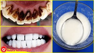 HOW TO REMOVE DENTAL PLAQUE IN 5 MINUTES NATURALLY WITHOUT GOING TO THE DENTIST [upl. by Nirhtak]