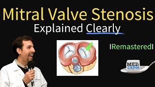 Mitral Valve Stenosis Diagnosis Treatment Pathophysiology [upl. by Iolande]