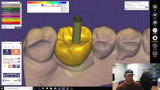 Scan Body and Screw Retain Implant Crown Design [upl. by Ahsied]