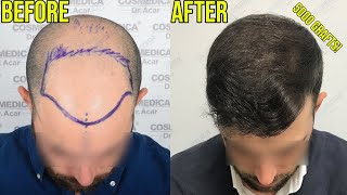 AMAZING HAIR TRANSPLANT TRANSFORMATIONS FOR NORWOOD 5 HAIR LOSS [upl. by Jezabella800]