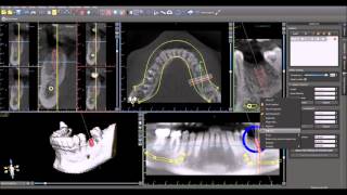 DICOM to Surgical Guide 15 Min [upl. by Einnim]