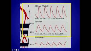 How to Perform and Interpret Peripheral Arterial Doppler Examinations [upl. by Demetria]