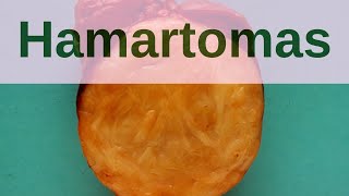 What are Hamartomas  Pathology mini tutorial [upl. by Nilak]