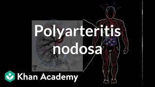 Polyarteritis nodosa  Circulatory System and Disease  NCLEXRN  Khan Academy [upl. by Ayad]