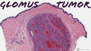 Glomus Tumours  Pathology mini tutorial [upl. by Rachael]