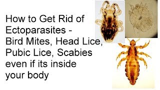 How to Get Rid of Lice Pubic Lice Scabies Bird Mites Ectoparasites even if its inside your body [upl. by Urania412]