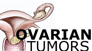 Ovarian Pathology amp Tumors [upl. by Eico]