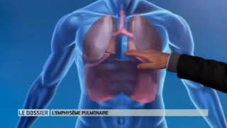 Emphysème pulmonaire [upl. by Ardnoel]