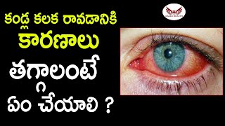 కండ్ల కలక తగ్గాలంటే  Conjunctivitis  Kalla Kalaka  Eagle Health [upl. by Naasar]