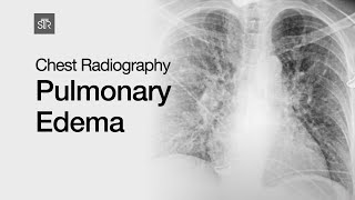 Chest Radiography Pulmonary Edema [upl. by Ronoh]