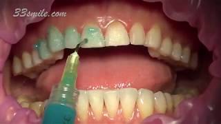 Prepless Veneers Permanent Teeth Whitening [upl. by Anabella]