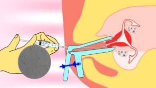 Intrauterine insemination IUI videoflv about infertility and ivf treatment [upl. by Aneles634]