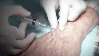 Aspiration of ganglion cyst [upl. by Ordnael610]