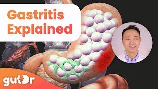 What is Gastritis  The GutDr Explains 3D Gut Animation [upl. by Akinnej]