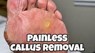 CALLUS REMOVAL FROM FEET PAINLESS PROCEDURE [upl. by Ffoeg566]