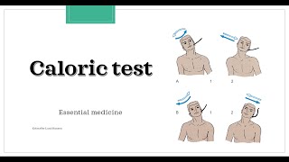 Caloric test Essential medicine [upl. by Tybalt751]