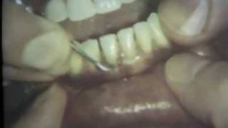 Scaling and Root Planing Part II Mandibular Teeth [upl. by Aamsa]