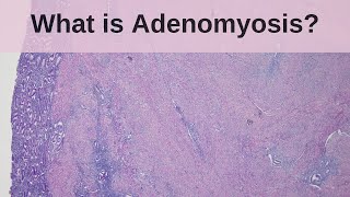 What is Adenomyosis  Pathology mini tutorial [upl. by Blatman942]