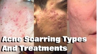 HOW TO TREAT ACNE SCARRING Remove Mild Moderate amp Severe Acne Scars [upl. by Whitten874]