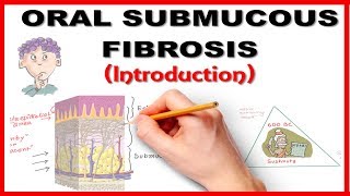 Oral Submucous Fibrosis OSMF Introduction [upl. by Eusassilem454]