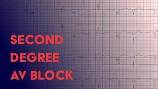 Second Degree Heart Block  Electrocardiogram ECGEKG Interpretation [upl. by Heid978]