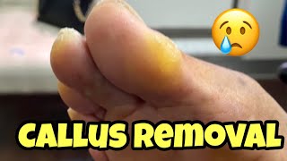 EXTREMELY SATISFYING CALLUS REMOVAL FROM THE FOOT [upl. by Aitnauq317]