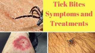 Tick Bites Symptoms and Treatments [upl. by Melly]