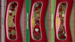 ATHEROSCLEROSIS and CARDIOVASCULAR DISEASE [upl. by Yenwat657]