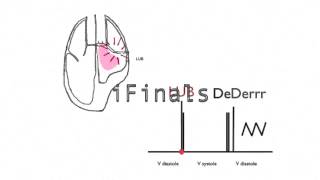 Mitral stenosis murmur [upl. by Merwyn]