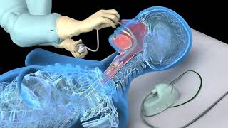 Nasotracheal suctioning NTS  3D animation [upl. by Arocahs]