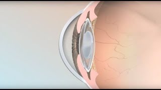 Multifocal Intraocular Lens How Does It Work [upl. by Hgeilyak]