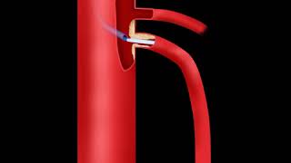 Superior Mesenteric Artery Stenting Animation [upl. by Rein584]