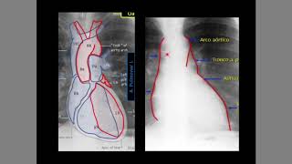 Radiografía de Tórax [upl. by Eltsyrc]