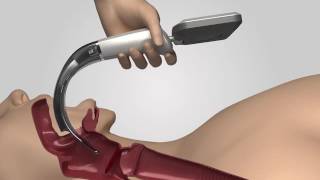 Video Laryngoscope iS3 L training video [upl. by Seppala]