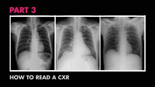 How XRays Work  How to Read a Chest XRay Part 3  MEDZCOOL [upl. by Nagy]